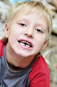 childs broken tooth, chipped tooth, 