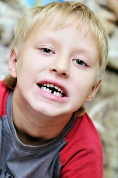 childs broken tooth, chipped tooth,